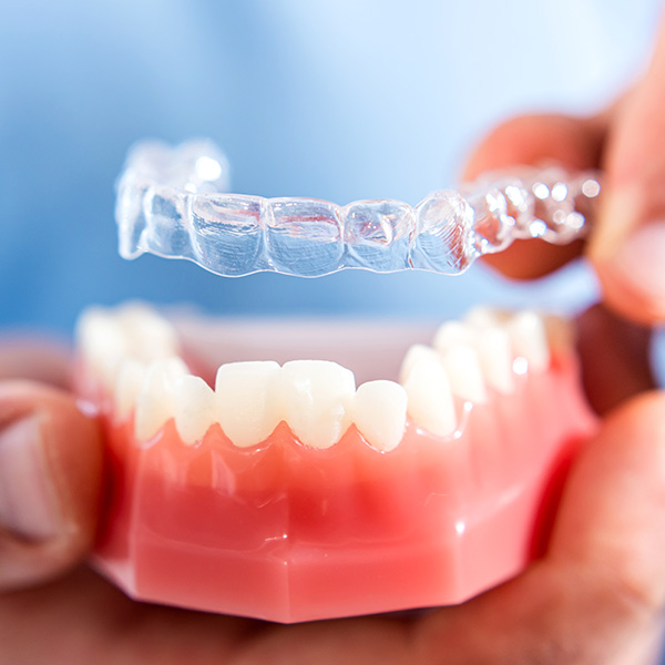 Invisible or Clear Aligners