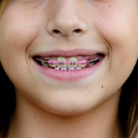 Traditional Braces